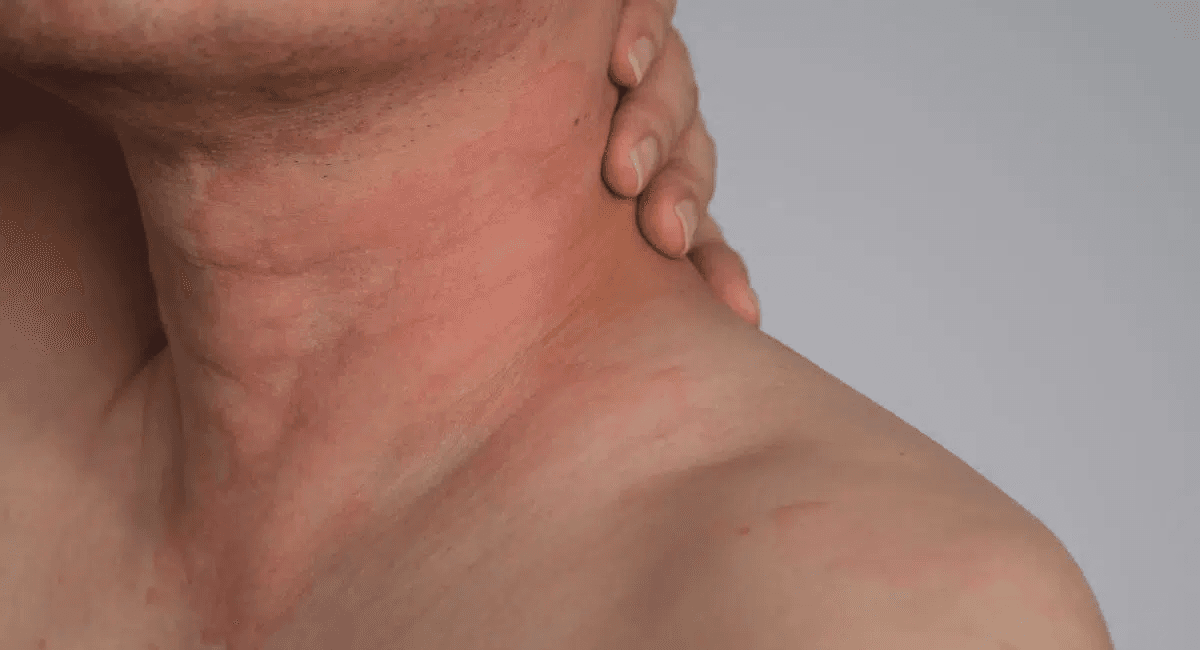 Skin reaction — redness and inflammation on neck